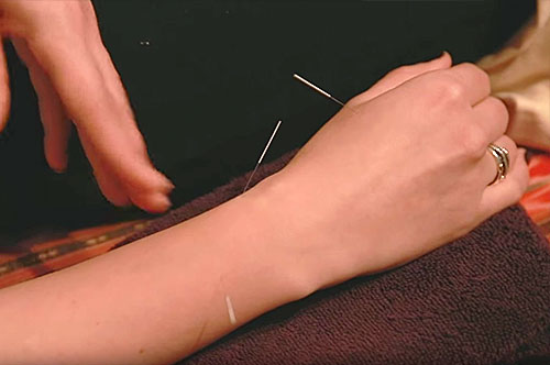 Best Acupuncture NYC - De'Qi Health New York City